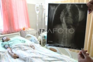 Tentu, mari kita susun artikel informatif tentang penyakit langka di tahun 2025.