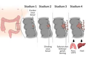 Kanker Usus: Mengenali Gejala Awal untuk Deteksi Dini
